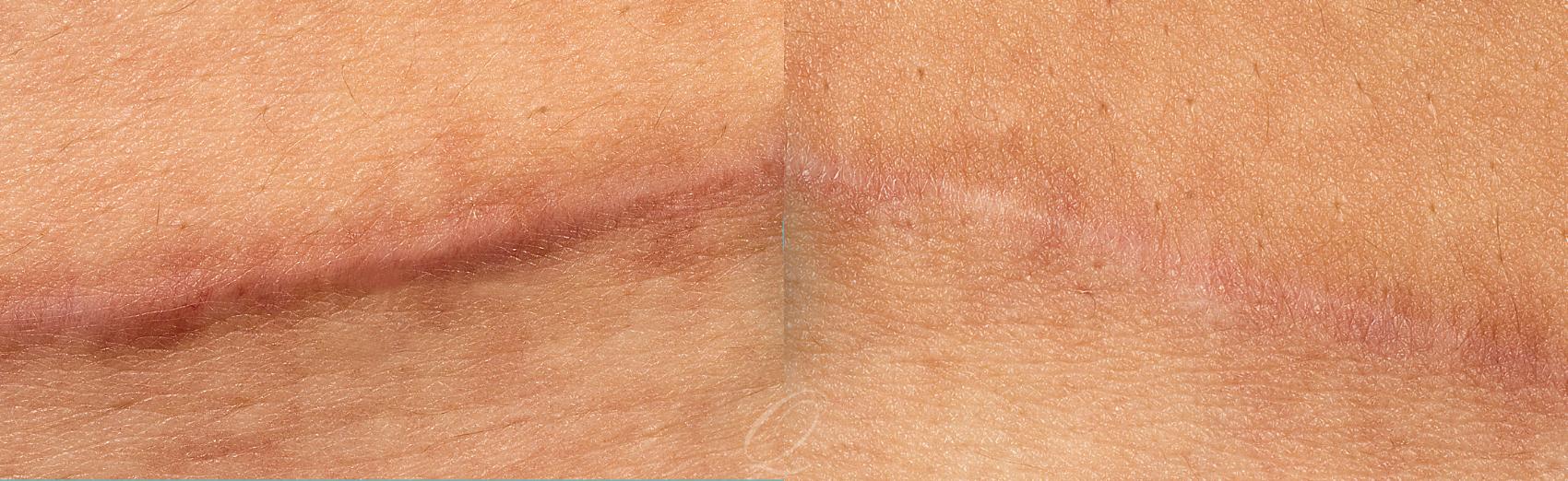 Scar Revision/Therapies Case 254 Before & After View #1 | Serving Rochester, Syracuse & Buffalo, NY | Quatela Center for Plastic Surgery
