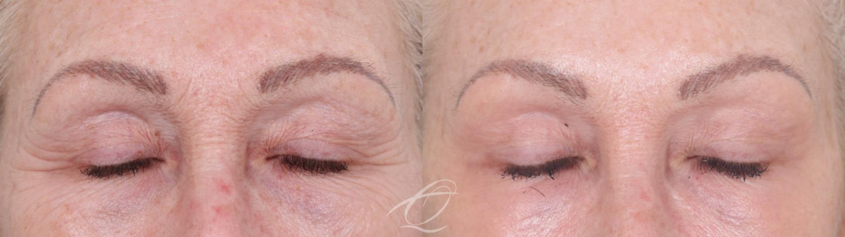 Skin Resurfacing Case 1002021 Before & After Eyes closed | Serving Rochester, Syracuse & Buffalo, NY | Quatela Center for Plastic Surgery