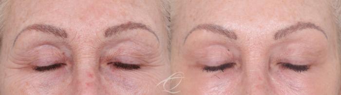 Skin Resurfacing Case 1002021 Before & After Eyes closed | Serving Rochester, Syracuse & Buffalo, NY | Quatela Center for Plastic Surgery