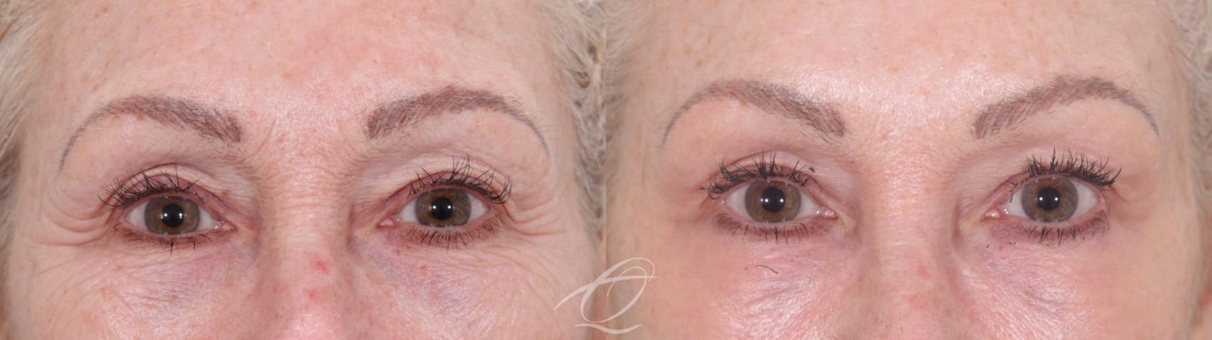Skin Resurfacing Case 1002021 Before & After Front | Serving Rochester, Syracuse & Buffalo, NY | Quatela Center for Plastic Surgery