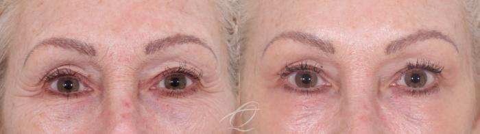 Skin Resurfacing Case 1002021 Before & After Front | Serving Rochester, Syracuse & Buffalo, NY | Quatela Center for Plastic Surgery