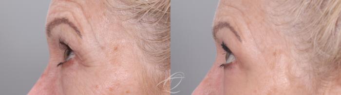 Skin Resurfacing Case 1002021 Before & After Left Side | Serving Rochester, Syracuse & Buffalo, NY | Quatela Center for Plastic Surgery