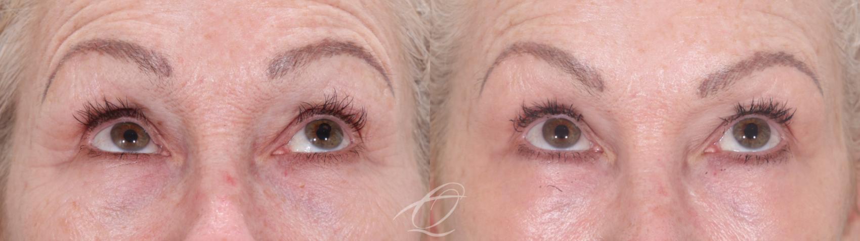 Skin Resurfacing Case 1002021 Before & After Looking up | Serving Rochester, Syracuse & Buffalo, NY | Quatela Center for Plastic Surgery