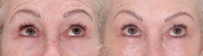 Skin Resurfacing Case 1002021 Before & After Looking up | Serving Rochester, Syracuse & Buffalo, NY | Quatela Center for Plastic Surgery