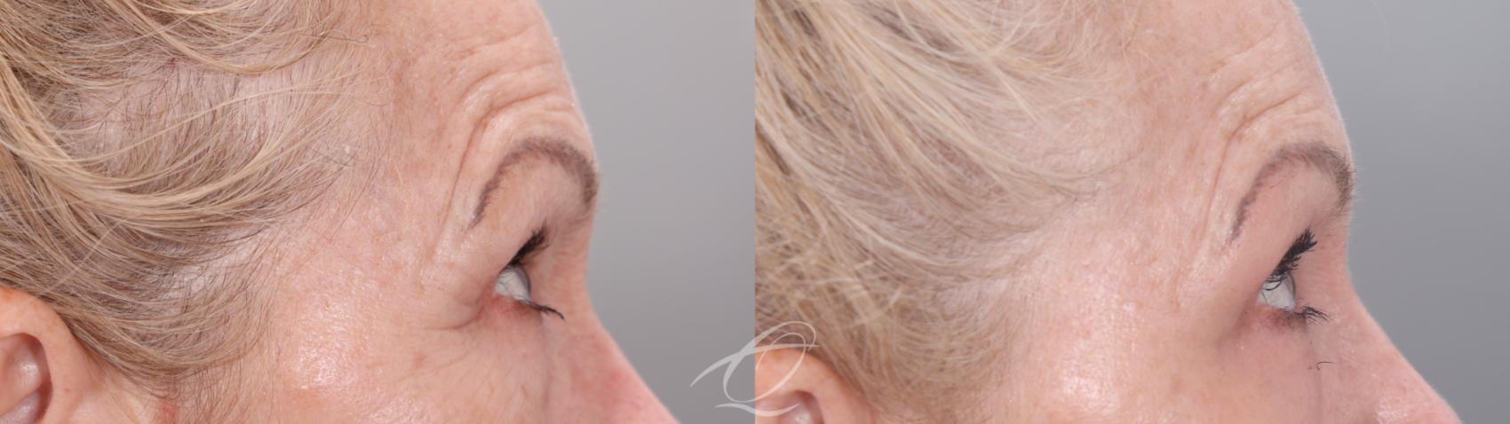 Skin Resurfacing Case 1002021 Before & After Right Side | Serving Rochester, Syracuse & Buffalo, NY | Quatela Center for Plastic Surgery