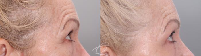 Skin Resurfacing Case 1002021 Before & After Right Side | Serving Rochester, Syracuse & Buffalo, NY | Quatela Center for Plastic Surgery