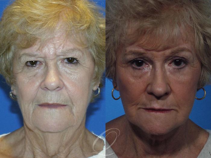 Skin Resurfacing Case 130 Before & After View #1 | Serving Rochester, Syracuse & Buffalo, NY | Quatela Center for Plastic Surgery