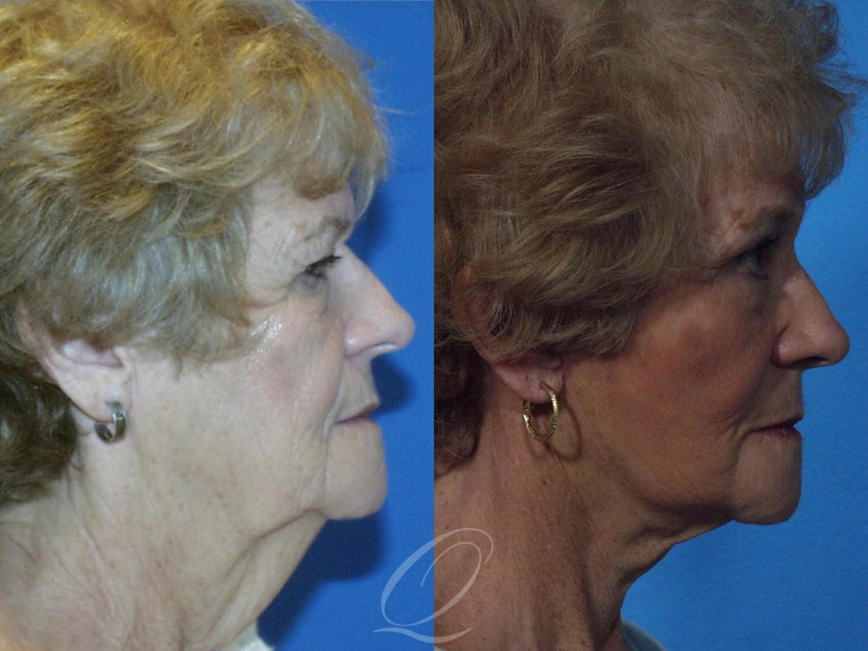 Skin Resurfacing Case 130 Before & After View #2 | Serving Rochester, Syracuse & Buffalo, NY | Quatela Center for Plastic Surgery
