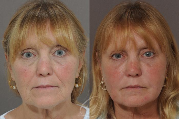 Skin Resurfacing Case 178 Before & After View #1 | Serving Rochester, Syracuse & Buffalo, NY | Quatela Center for Plastic Surgery