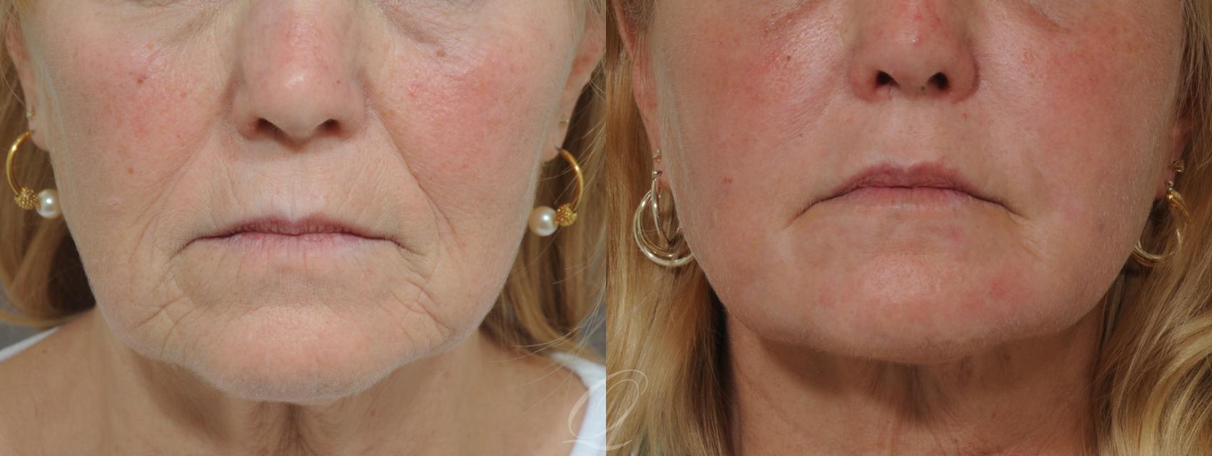 Skin Resurfacing Case 178 Before & After View #2 | Serving Rochester, Syracuse & Buffalo, NY | Quatela Center for Plastic Surgery