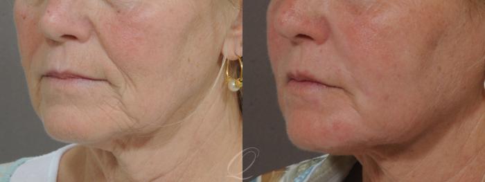 Skin Resurfacing Case 178 Before & After View #3 | Serving Rochester, Syracuse & Buffalo, NY | Quatela Center for Plastic Surgery