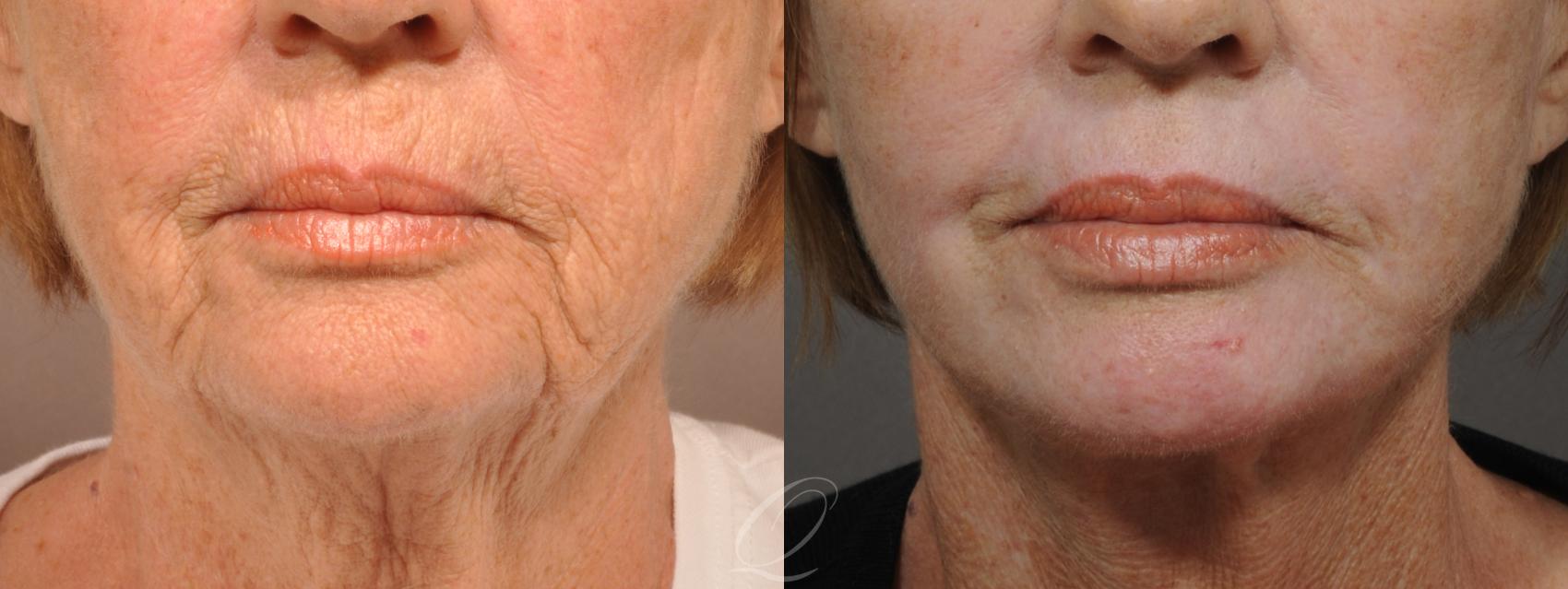 Skin Resurfacing Case 179 Before & After View #1 | Serving Rochester, Syracuse & Buffalo, NY | Quatela Center for Plastic Surgery