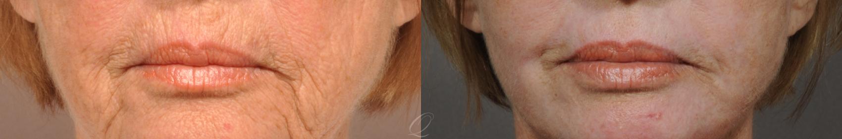 Skin Resurfacing Case 179 Before & After View #2 | Serving Rochester, Syracuse & Buffalo, NY | Quatela Center for Plastic Surgery