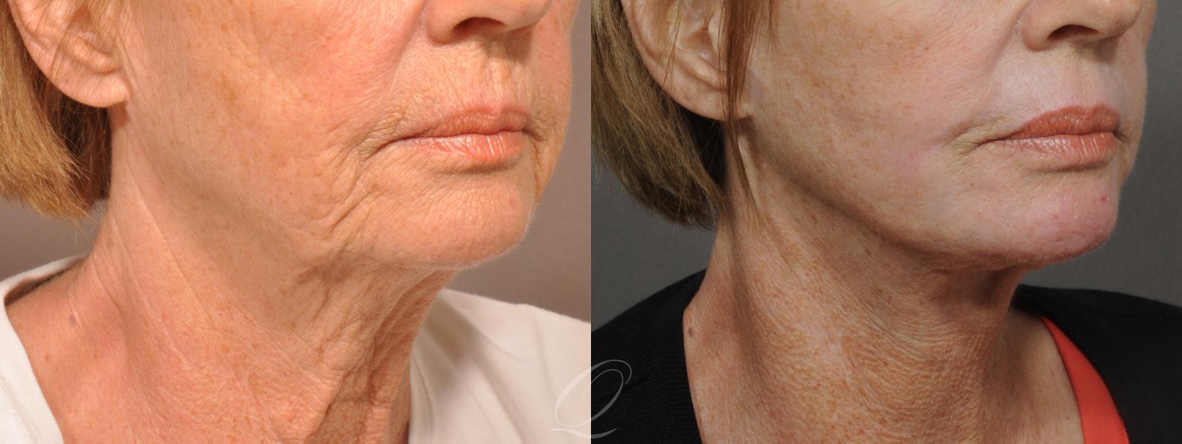 Skin Resurfacing Case 179 Before & After View #4 | Serving Rochester, Syracuse & Buffalo, NY | Quatela Center for Plastic Surgery