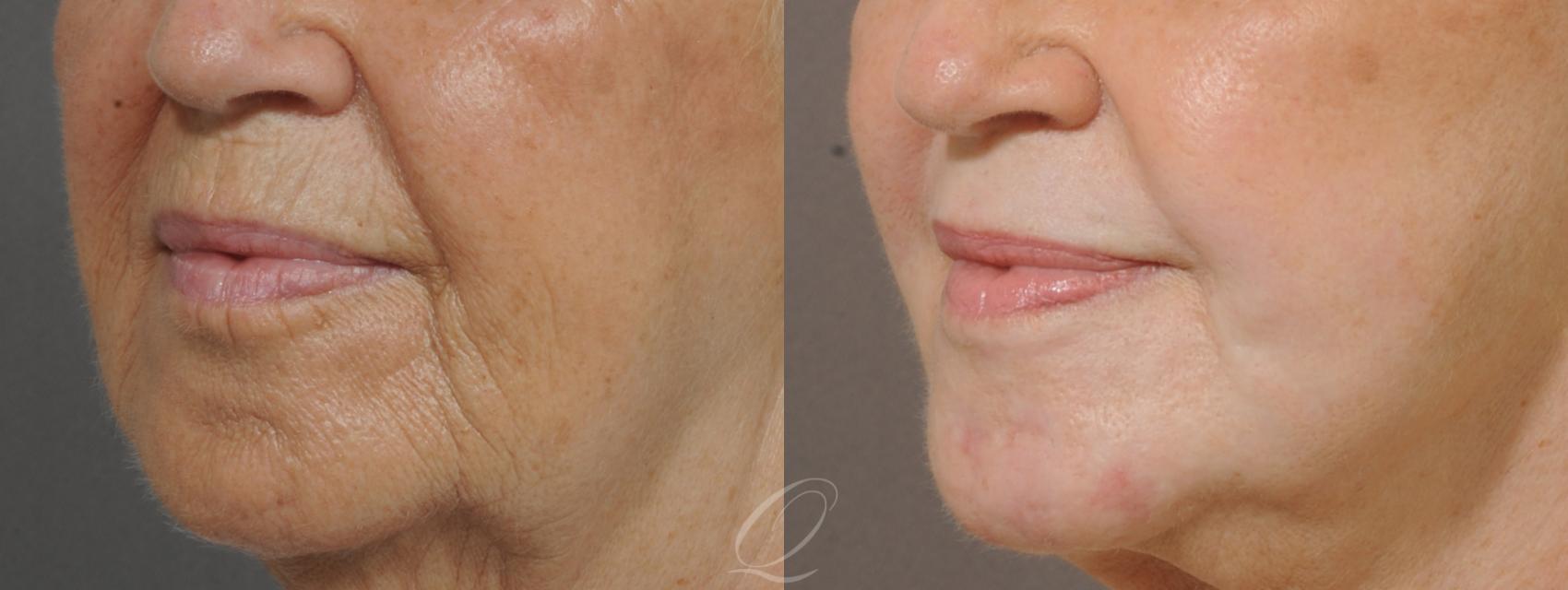 Skin Resurfacing Case 180 Before & After View #3 | Serving Rochester, Syracuse & Buffalo, NY | Quatela Center for Plastic Surgery