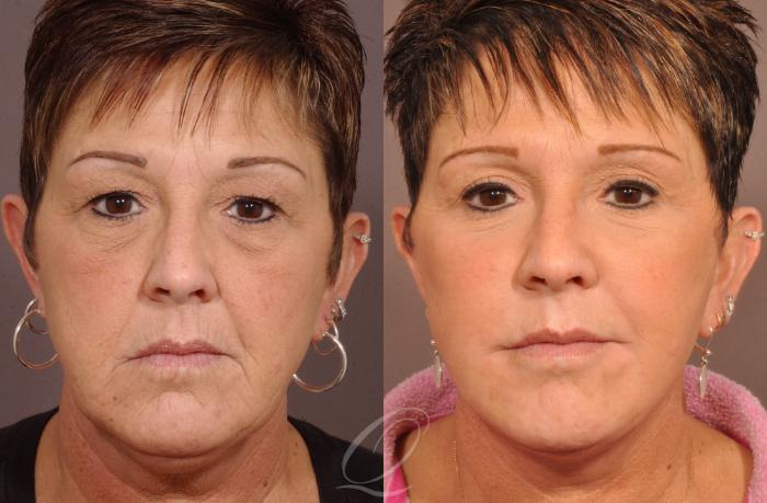 Skin Resurfacing Case 181 Before & After View #1 | Serving Rochester, Syracuse & Buffalo, NY | Quatela Center for Plastic Surgery