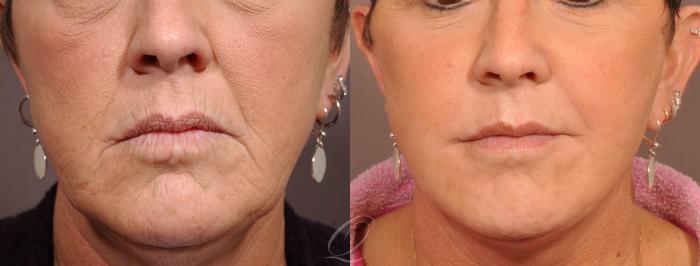 Skin Resurfacing Case 181 Before & After View #2 | Serving Rochester, Syracuse & Buffalo, NY | Quatela Center for Plastic Surgery
