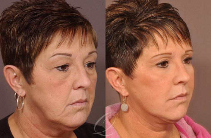 Skin Resurfacing Case 181 Before & After View #3 | Serving Rochester, Syracuse & Buffalo, NY | Quatela Center for Plastic Surgery