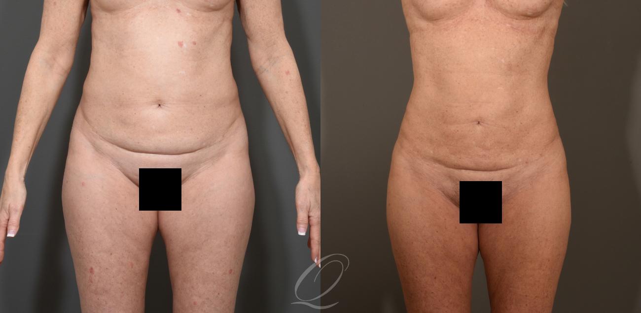 SmartLipo Laser Body Sculpting Case 1386 Before & After Front | Serving Rochester, Syracuse & Buffalo, NY | Quatela Center for Plastic Surgery
