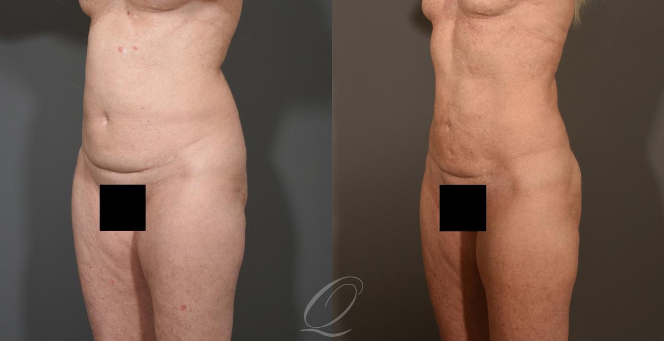 SmartLipo Laser Body Sculpting Case 1386 Before & After Left Oblique | Serving Rochester, Syracuse & Buffalo, NY | Quatela Center for Plastic Surgery