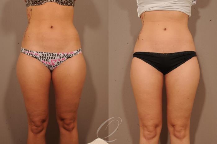 SmartLipo Laser Body Sculpting Case 1065 Before & After View #1 | Serving Rochester, Syracuse & Buffalo, NY | Quatela Center for Plastic Surgery