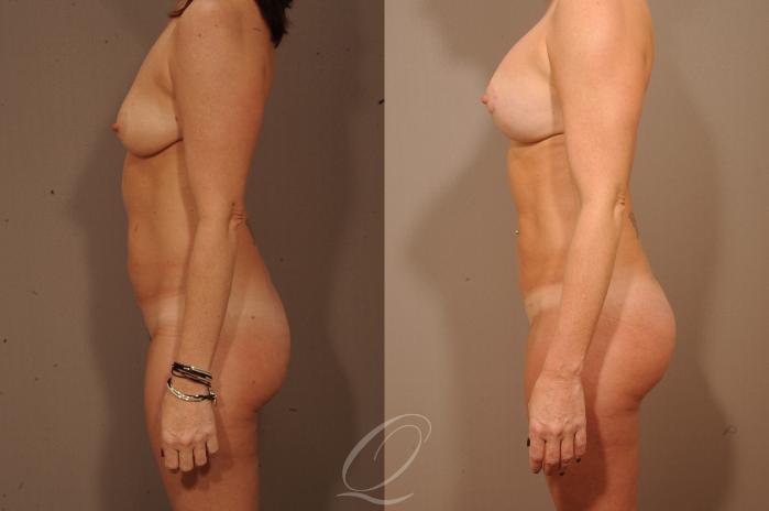 SmartLipo Laser Body Sculpting Case 1144 Before & After View #3 | Serving Rochester, Syracuse & Buffalo, NY | Quatela Center for Plastic Surgery