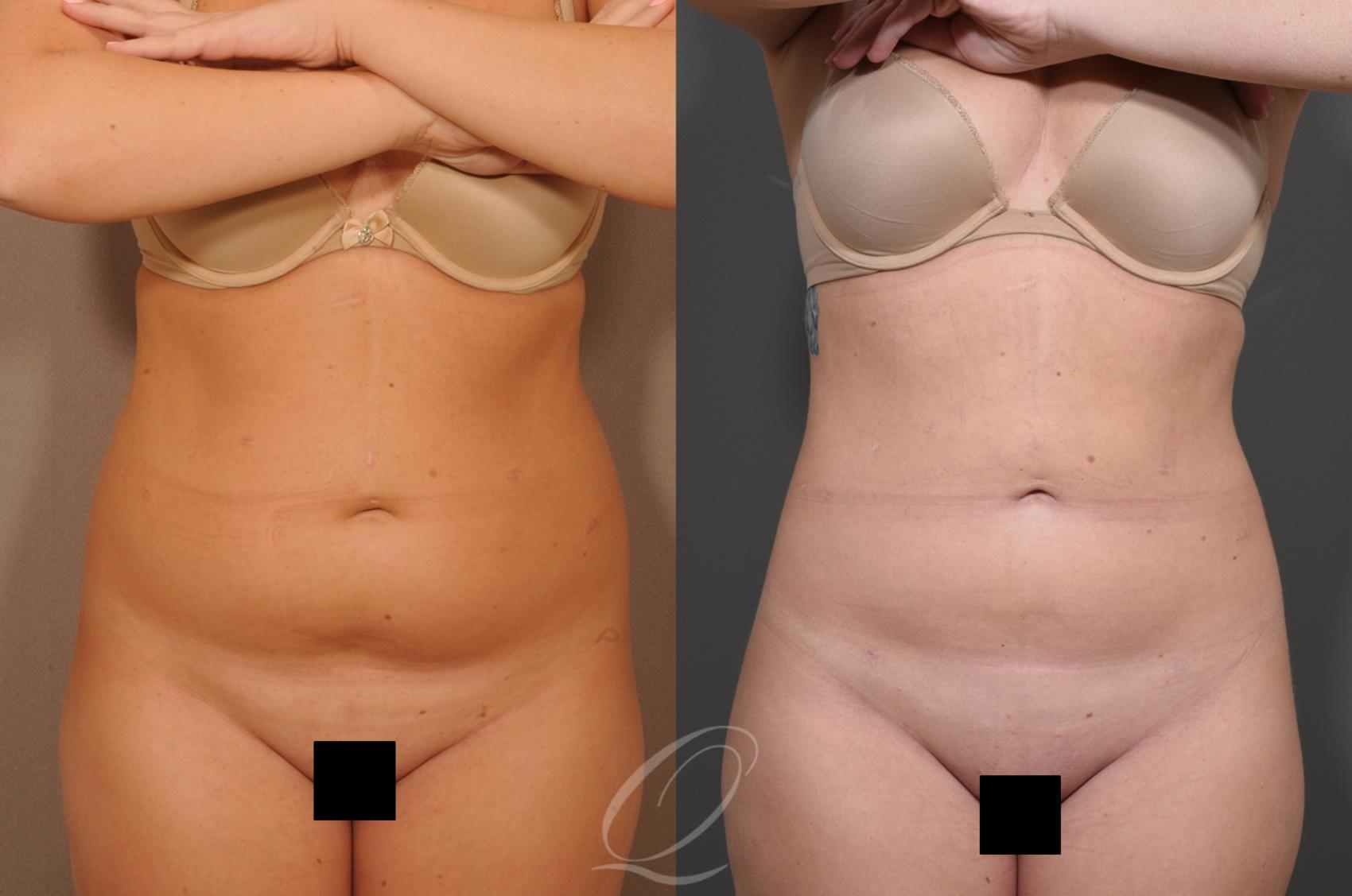 SmartLipo Laser Body Sculpting Case 1329 Before & After View #1 | Serving Rochester, Syracuse & Buffalo, NY | Quatela Center for Plastic Surgery