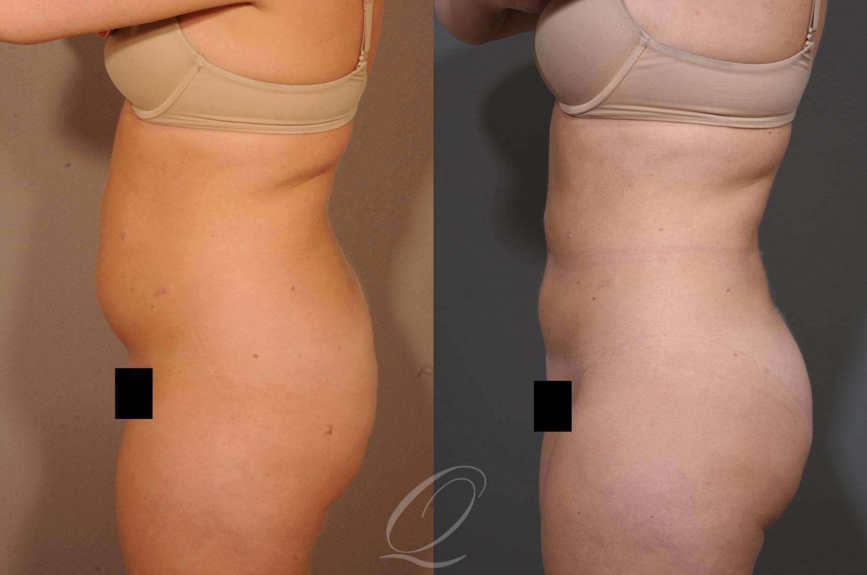 SmartLipo Laser Body Sculpting Case 1329 Before & After View #2 | Serving Rochester, Syracuse & Buffalo, NY | Quatela Center for Plastic Surgery