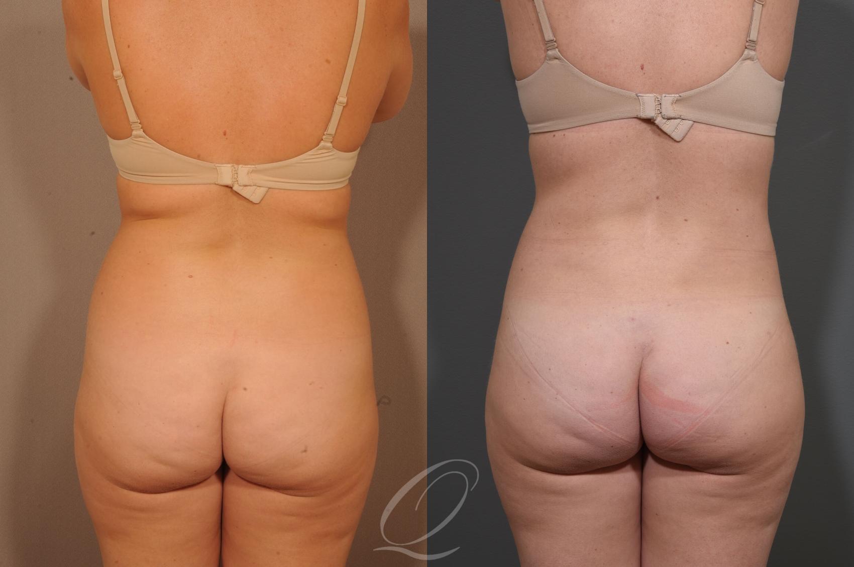 SmartLipo Laser Body Sculpting Case 1329 Before & After View #3 | Serving Rochester, Syracuse & Buffalo, NY | Quatela Center for Plastic Surgery