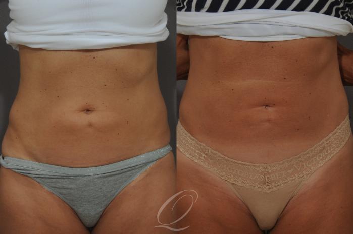 SmartLipo Laser Body Sculpting Case 202 Before & After View #1 | Serving Rochester, Syracuse & Buffalo, NY | Quatela Center for Plastic Surgery