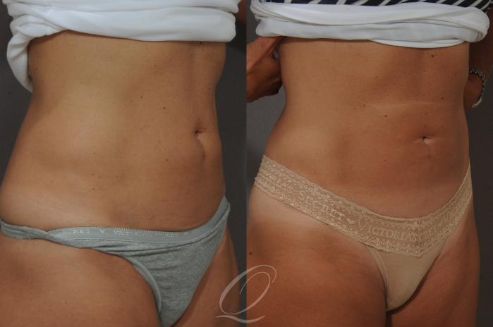 SmartLipo Laser Body Sculpting Before & After Photos Patient 202, Serving  Rochester, Syracuse & Buffalo, NY