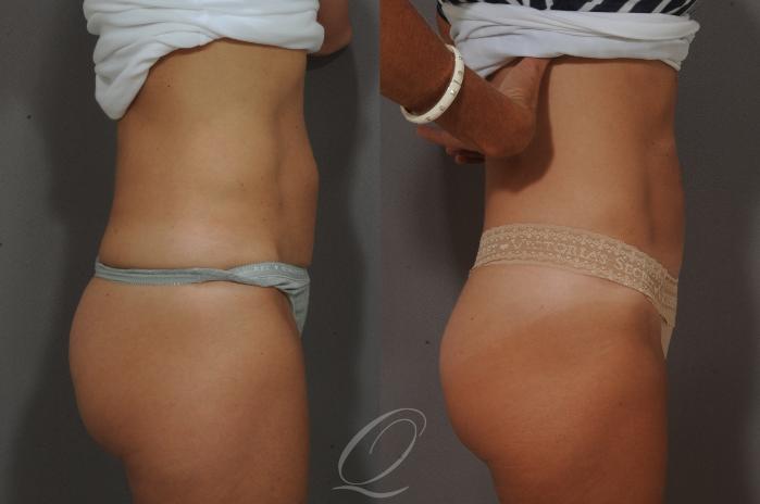 SmartLipo Laser Body Sculpting Case 202 Before & After View #3 | Serving Rochester, Syracuse & Buffalo, NY | Quatela Center for Plastic Surgery