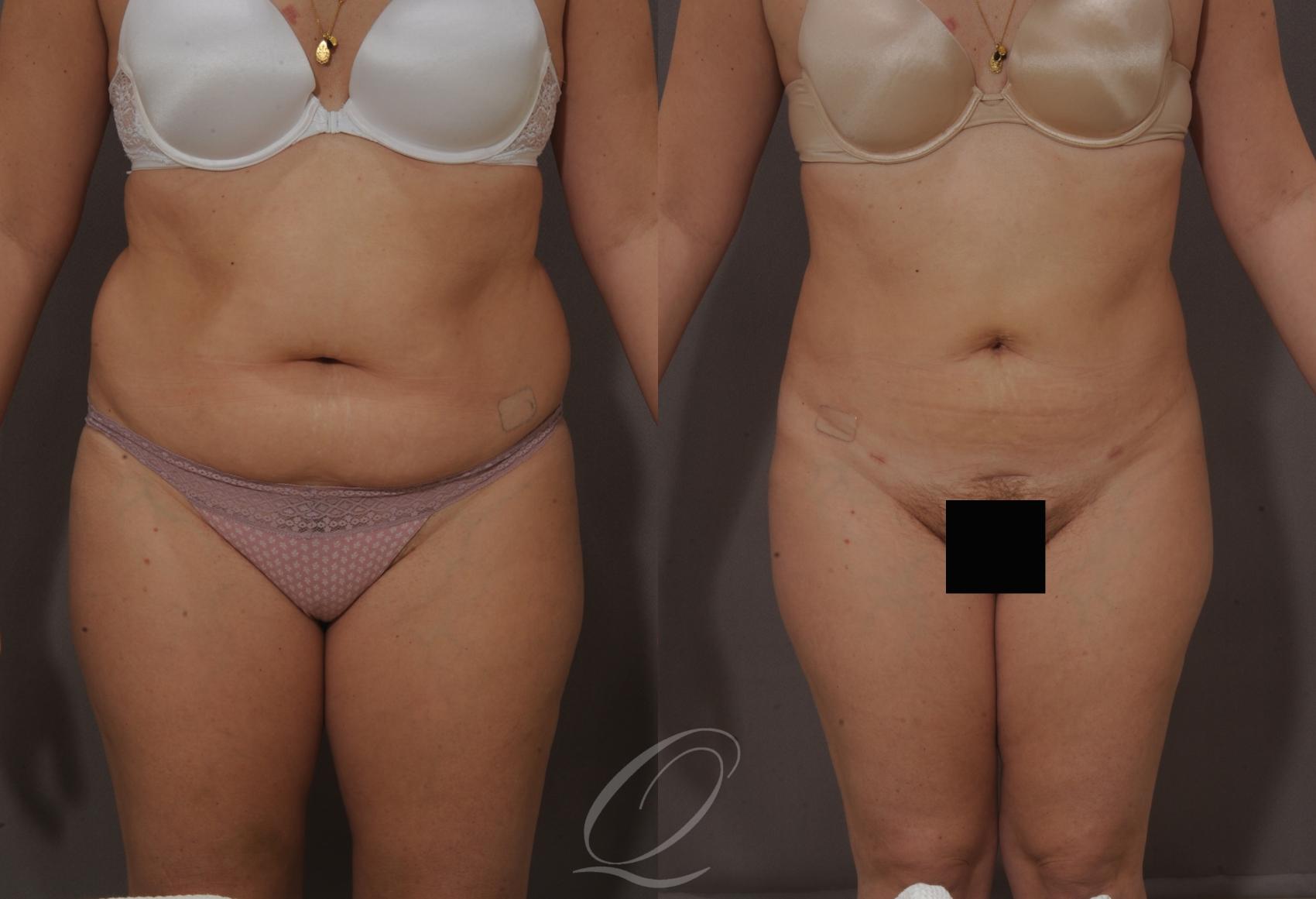 SmartLipo Laser Body Sculpting Case 203 Before & After View #1 | Serving Rochester, Syracuse & Buffalo, NY | Quatela Center for Plastic Surgery