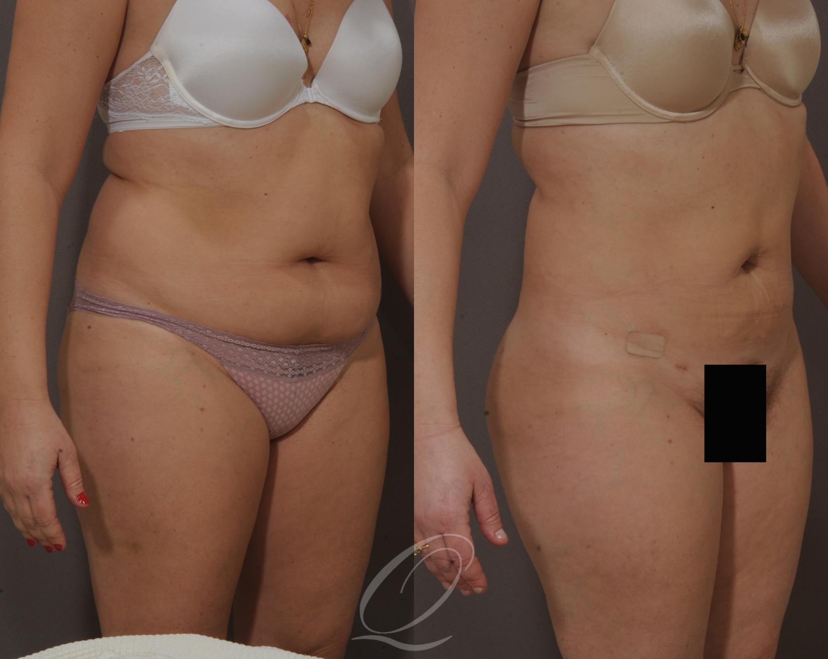SmartLipo Laser Body Sculpting Case 203 Before & After View #2 | Serving Rochester, Syracuse & Buffalo, NY | Quatela Center for Plastic Surgery