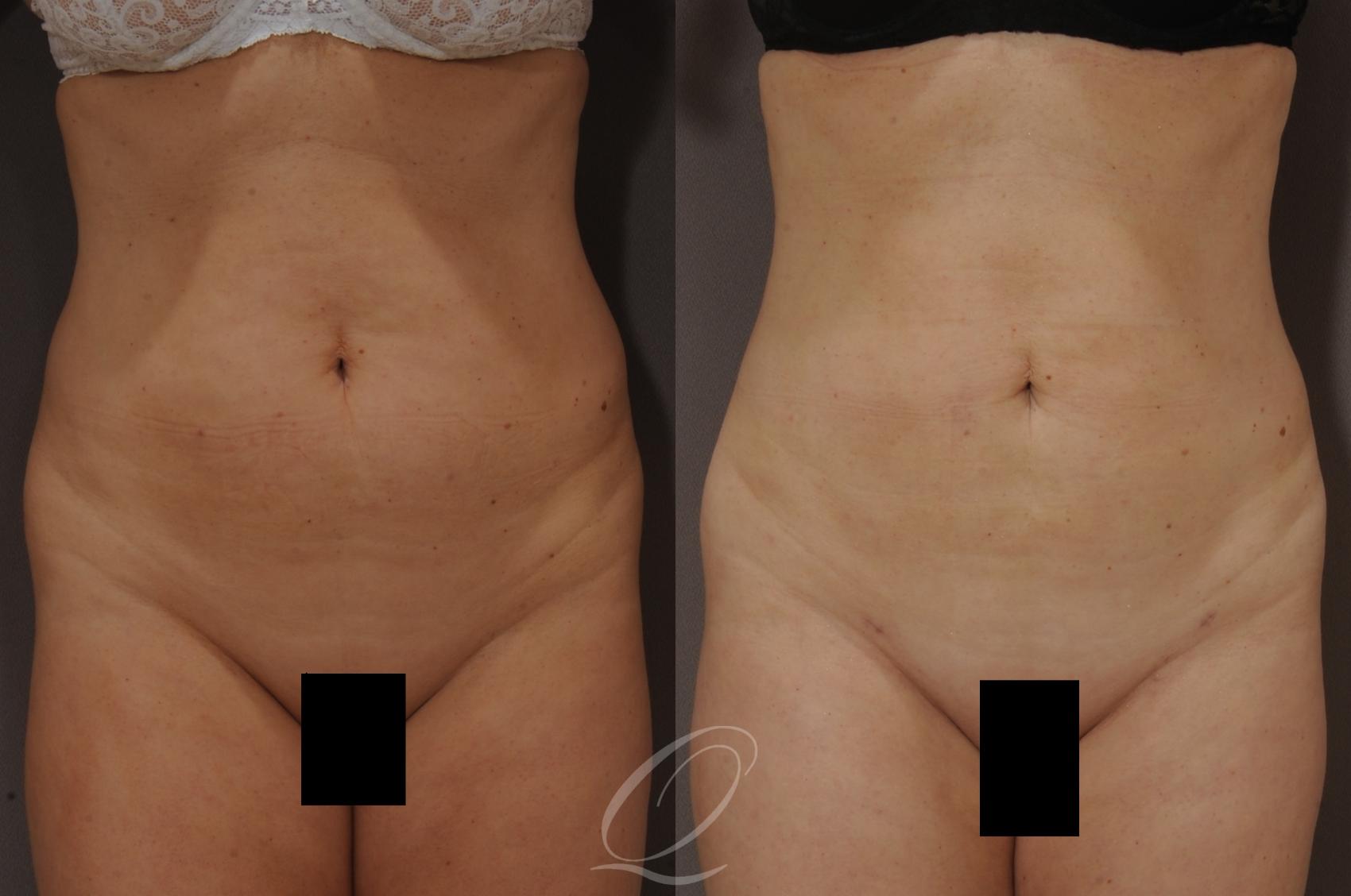 SmartLipo Laser Body Sculpting Case 205 Before & After View #1 | Serving Rochester, Syracuse & Buffalo, NY | Quatela Center for Plastic Surgery