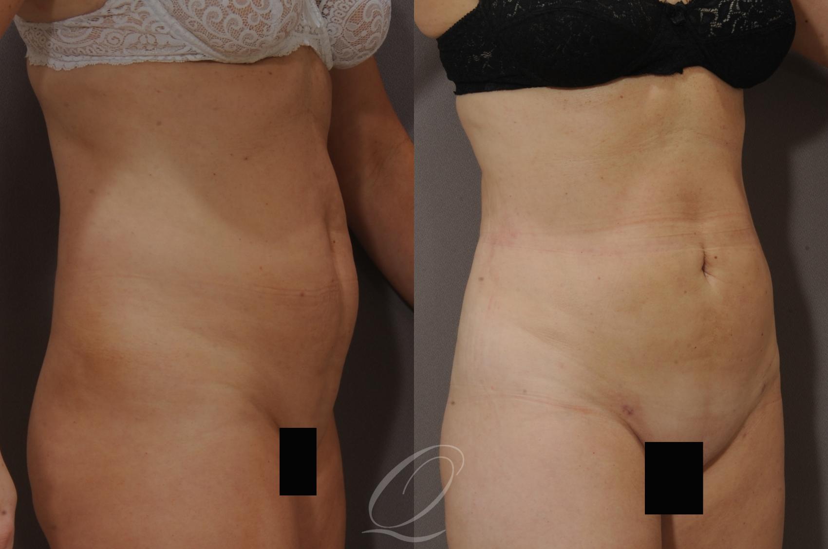 SmartLipo Laser Body Sculpting Case 205 Before & After View #2 | Serving Rochester, Syracuse & Buffalo, NY | Quatela Center for Plastic Surgery