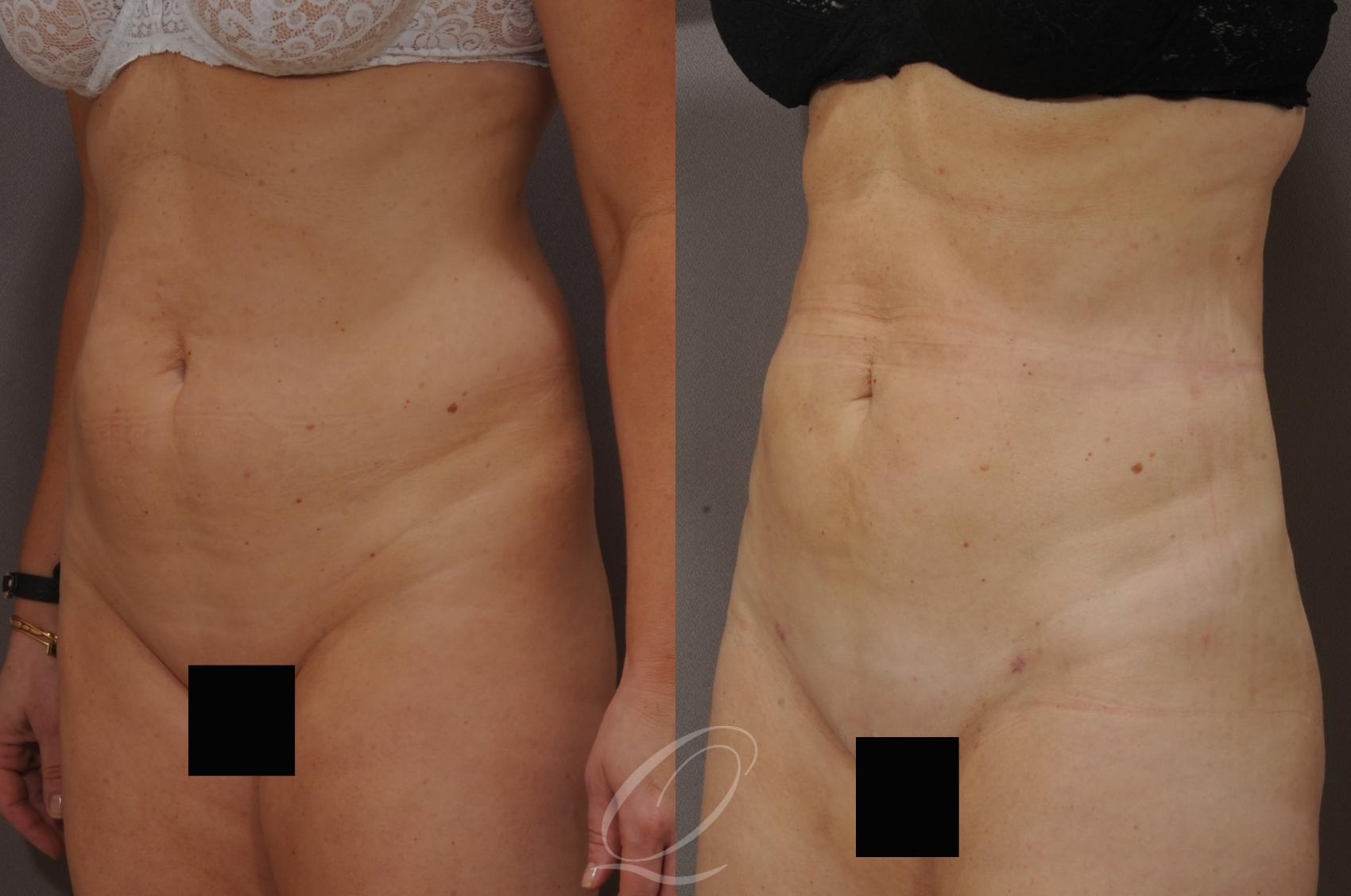 SmartLipo Laser Body Sculpting Case 205 Before & After View #3 | Serving Rochester, Syracuse & Buffalo, NY | Quatela Center for Plastic Surgery