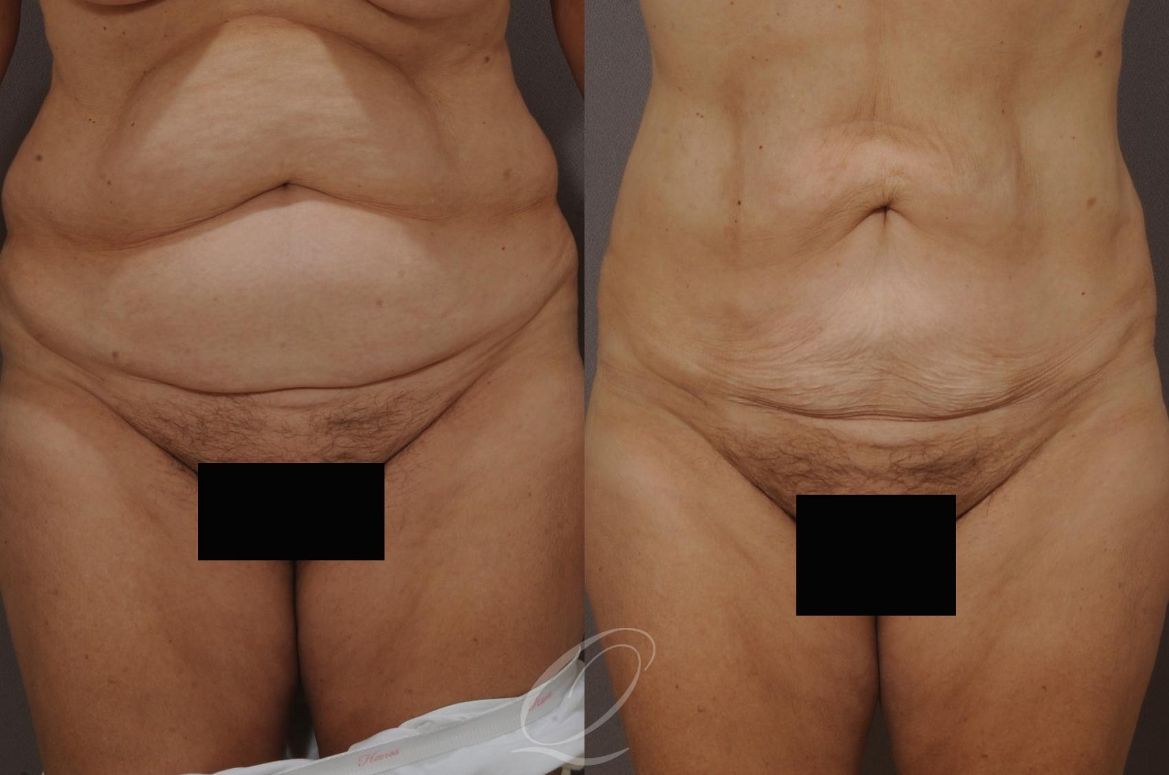 SmartLipo Laser Body Sculpting Case 206 Before & After View #1 | Serving Rochester, Syracuse & Buffalo, NY | Quatela Center for Plastic Surgery