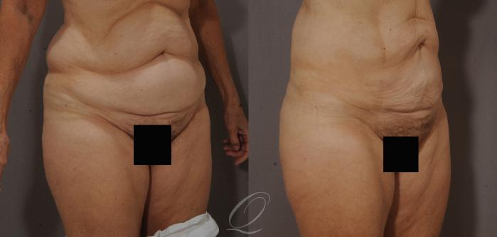 SmartLipo Laser Body Sculpting Case 206 Before & After View #2 | Serving Rochester, Syracuse & Buffalo, NY | Quatela Center for Plastic Surgery