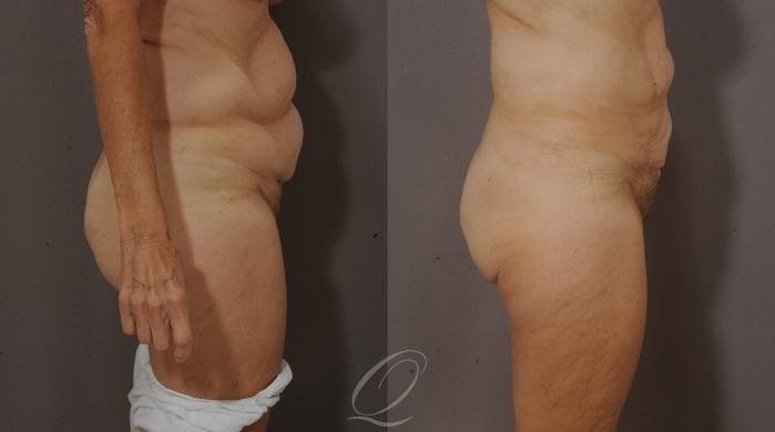 SmartLipo Laser Body Sculpting Case 206 Before & After View #3 | Serving Rochester, Syracuse & Buffalo, NY | Quatela Center for Plastic Surgery