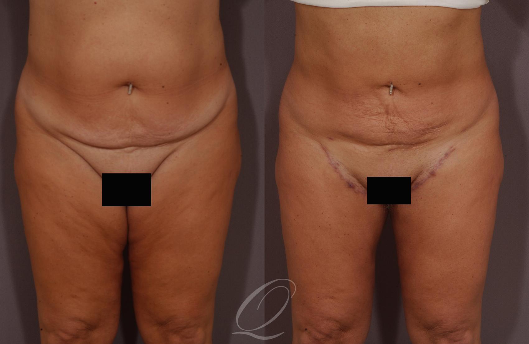 Thigh Lift Case 201 Before & After View #1 | Serving Rochester, Syracuse & Buffalo, NY | Quatela Center for Plastic Surgery
