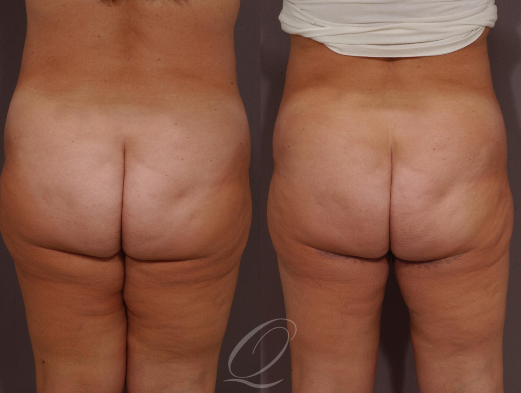Thigh Lift Case 201 Before & After View #2 | Serving Rochester, Syracuse & Buffalo, NY | Quatela Center for Plastic Surgery