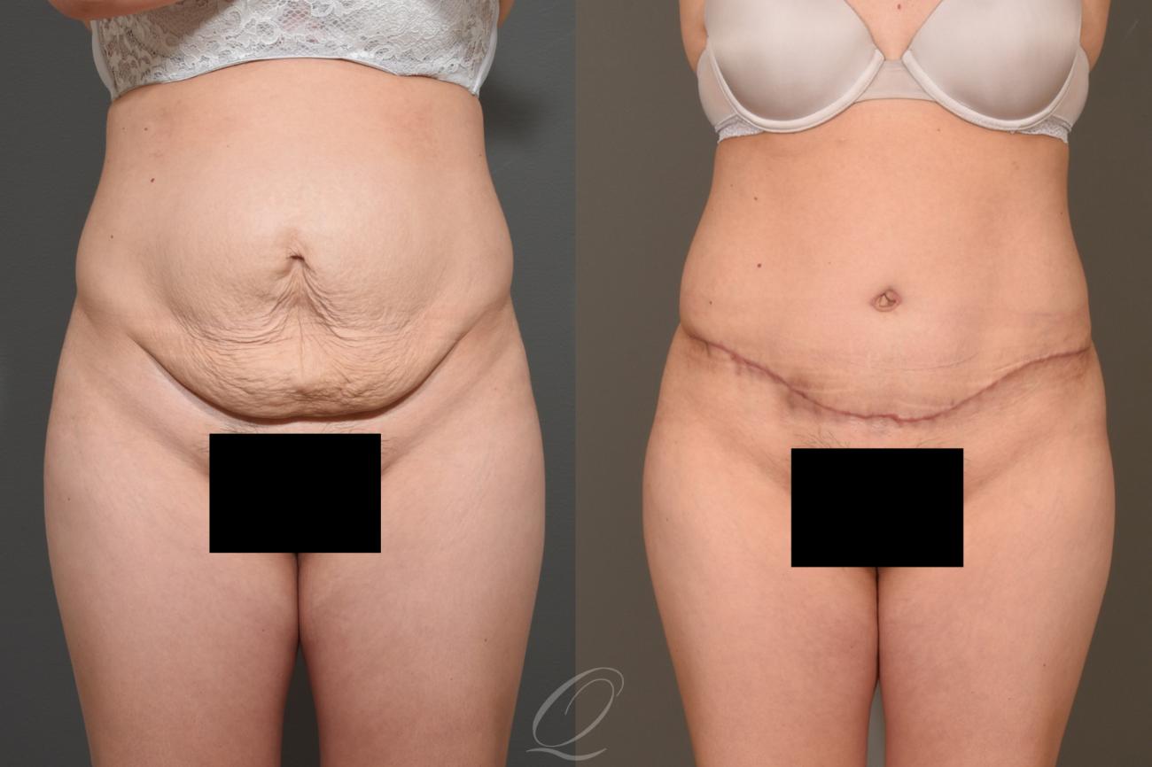 Tummy Tuck Case 373 Before & After View #1 | Serving Rochester, Syracuse & Buffalo, NY | Quatela Center for Plastic Surgery