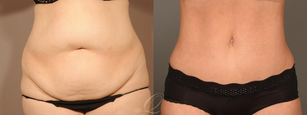 Tummy Tuck Case 394 Before & After Front | Serving Rochester, Syracuse & Buffalo, NY | Quatela Center for Plastic Surgery