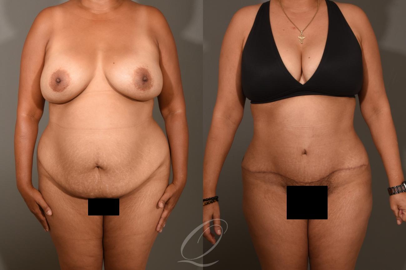Tummy Tuck Case 405 Before & After Front | Serving Rochester, Syracuse & Buffalo, NY | Quatela Center for Plastic Surgery