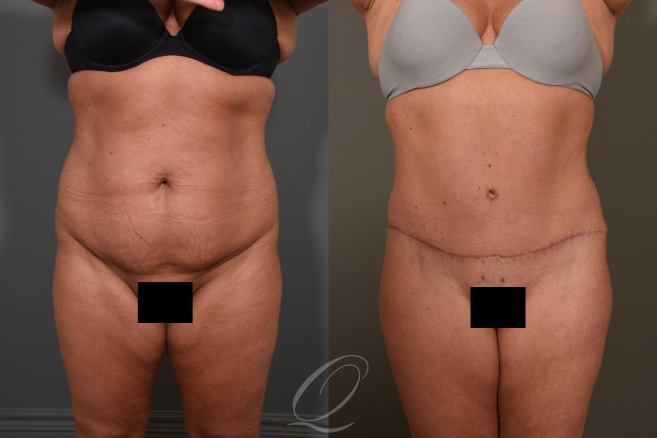 Tummy Tuck Case 1380 Before & After Front | Serving Rochester, Syracuse & Buffalo, NY | Quatela Center for Plastic Surgery