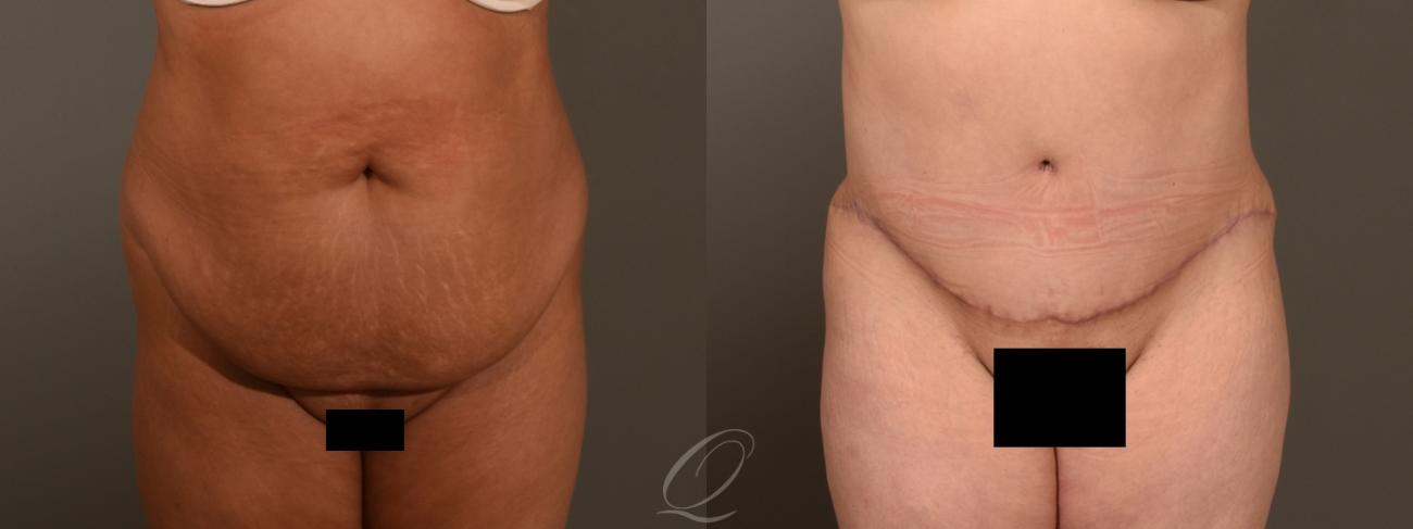 Tummy Tuck Case 1382 Before & After Front | Serving Rochester, Syracuse & Buffalo, NY | Quatela Center for Plastic Surgery