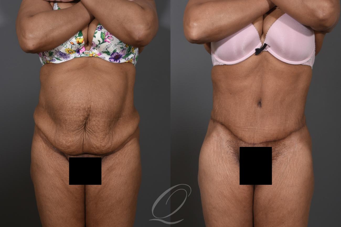 Tummy Tuck Case 1384 Before & After Front | Serving Rochester, Syracuse & Buffalo, NY | Quatela Center for Plastic Surgery