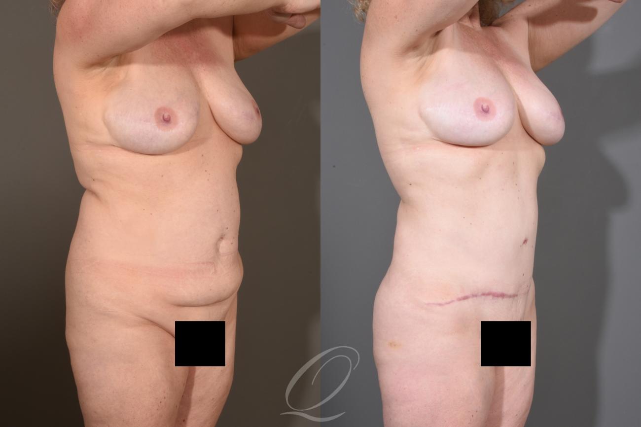 Breast Augmentation with Fat Transfer Case 1480 Before & After Right Oblique | Serving Rochester, Syracuse & Buffalo, NY | Quatela Center for Plastic Surgery