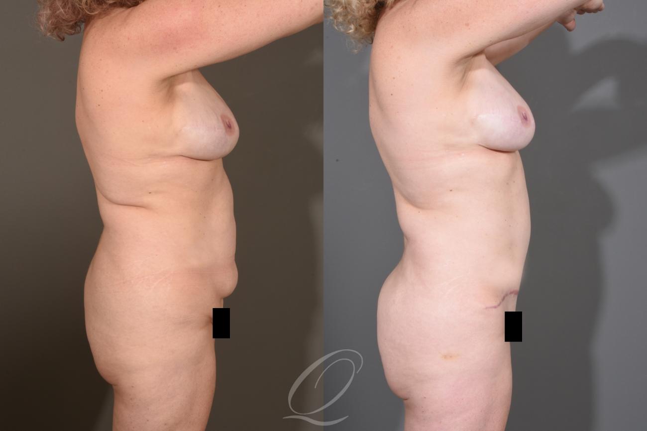 Breast Augmentation with Fat Transfer Case 1480 Before & After Right Side | Serving Rochester, Syracuse & Buffalo, NY | Quatela Center for Plastic Surgery